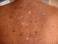 cancer de piele efecte
